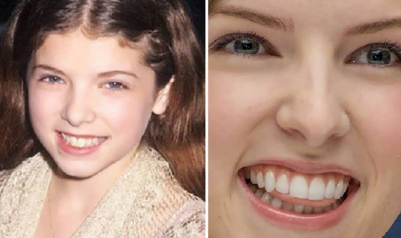 Did Anna Kendrick Get Dental Work On Her Teeth?