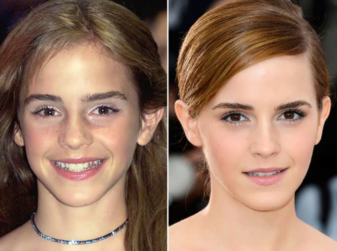 Emma Watson's Teeth Before and After