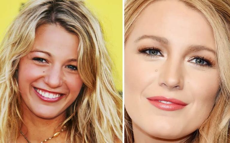 Does Blake Lively Have Plastic Surgery or Not? Let's Reveal! - Verge Campus