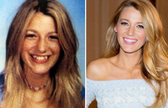 Does Blake Lively Have Plastic Surgery Or Not Let S Reveal Verge Campus