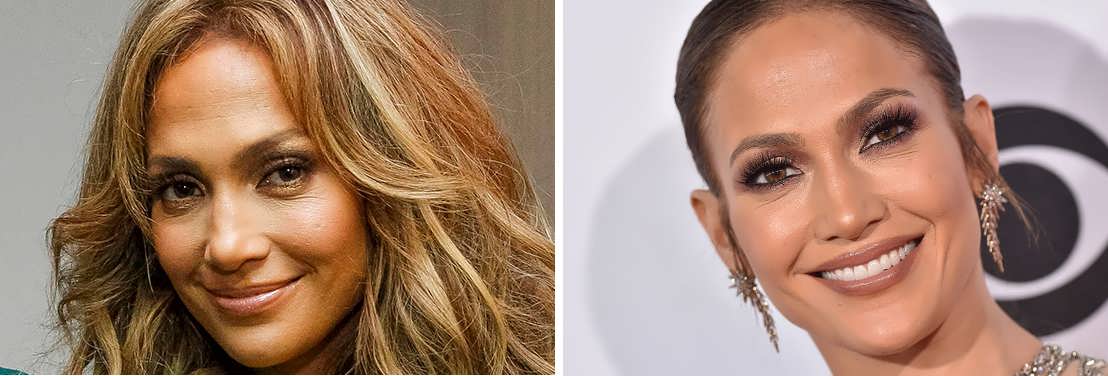 Does Jennifer Lopez Have Botox