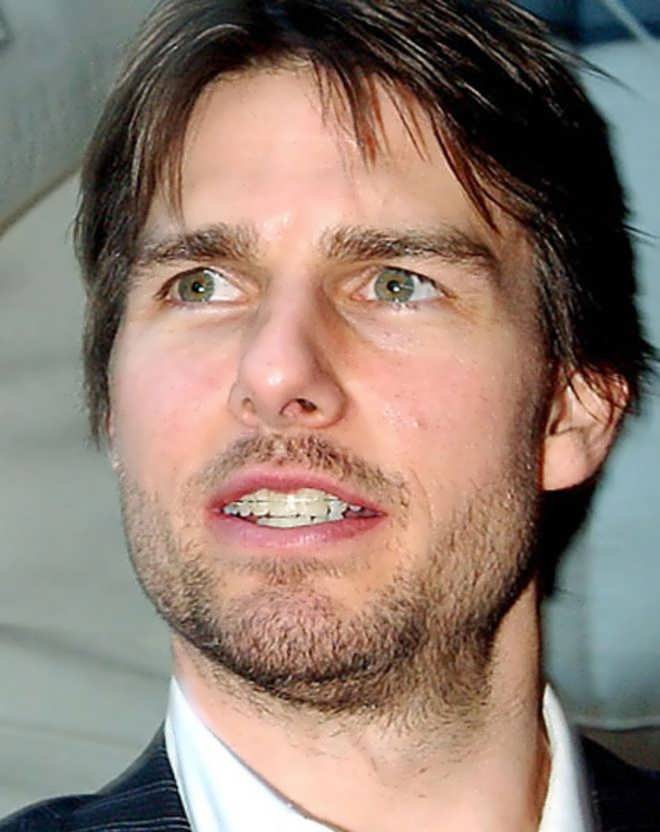 Tom Cruise's Front Teeth Alignment