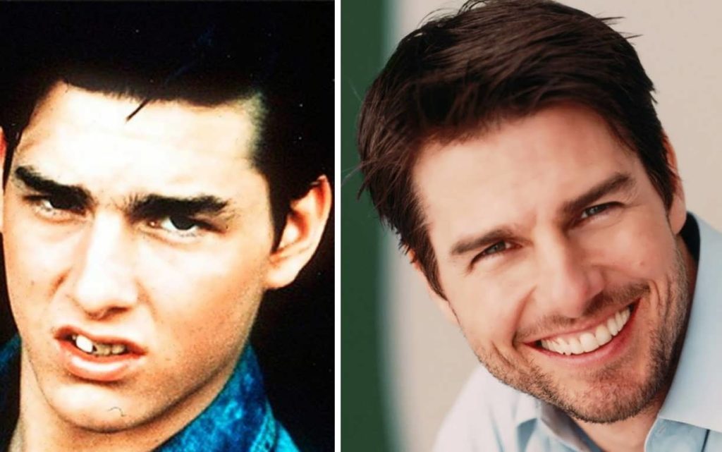 Tom Cruise's Teeth