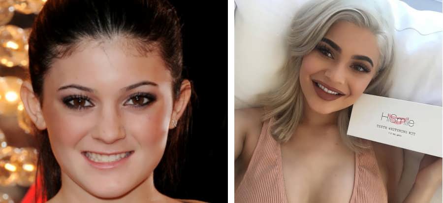 Kylie Jenner's Teeth Before and After