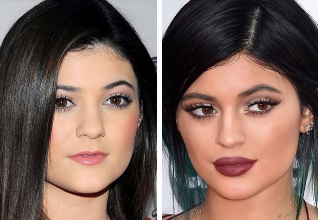 Did Kylie Jenner Have An Eye Surgery