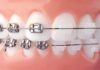 What Is The Difference Between Metal And Clear Braces