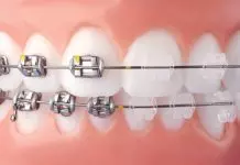 What Is The Difference Between Metal And Clear Braces