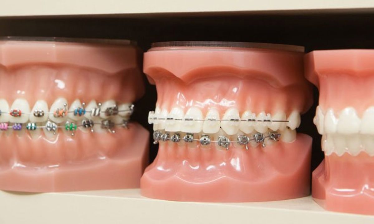 How Long Do Braces Hurt for When You First Get Them? Verge Campus